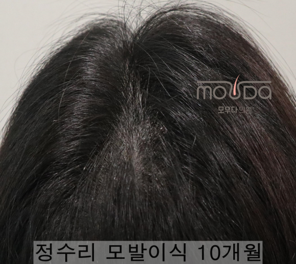 6. 여성정수리모발이식